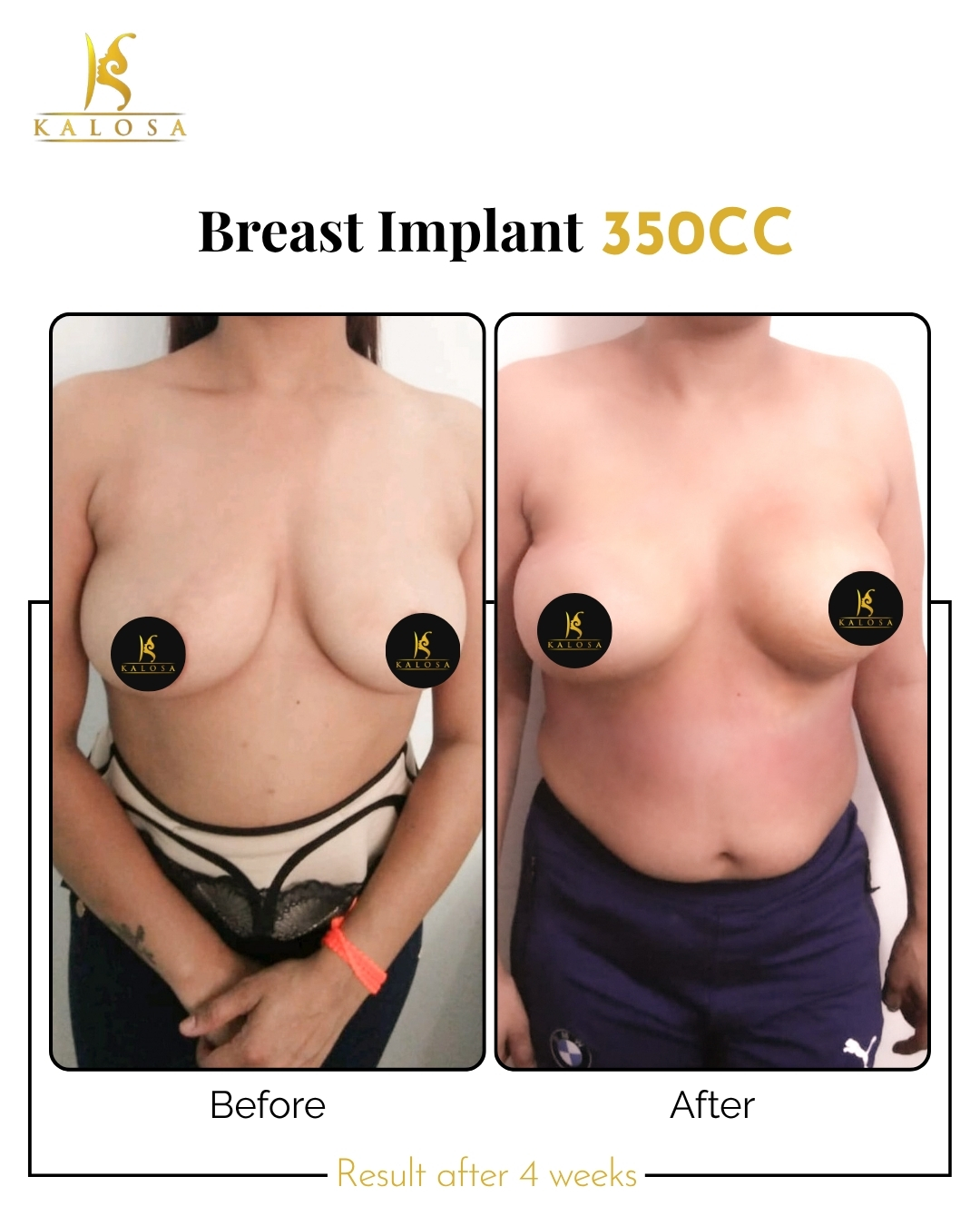 Breast Implant