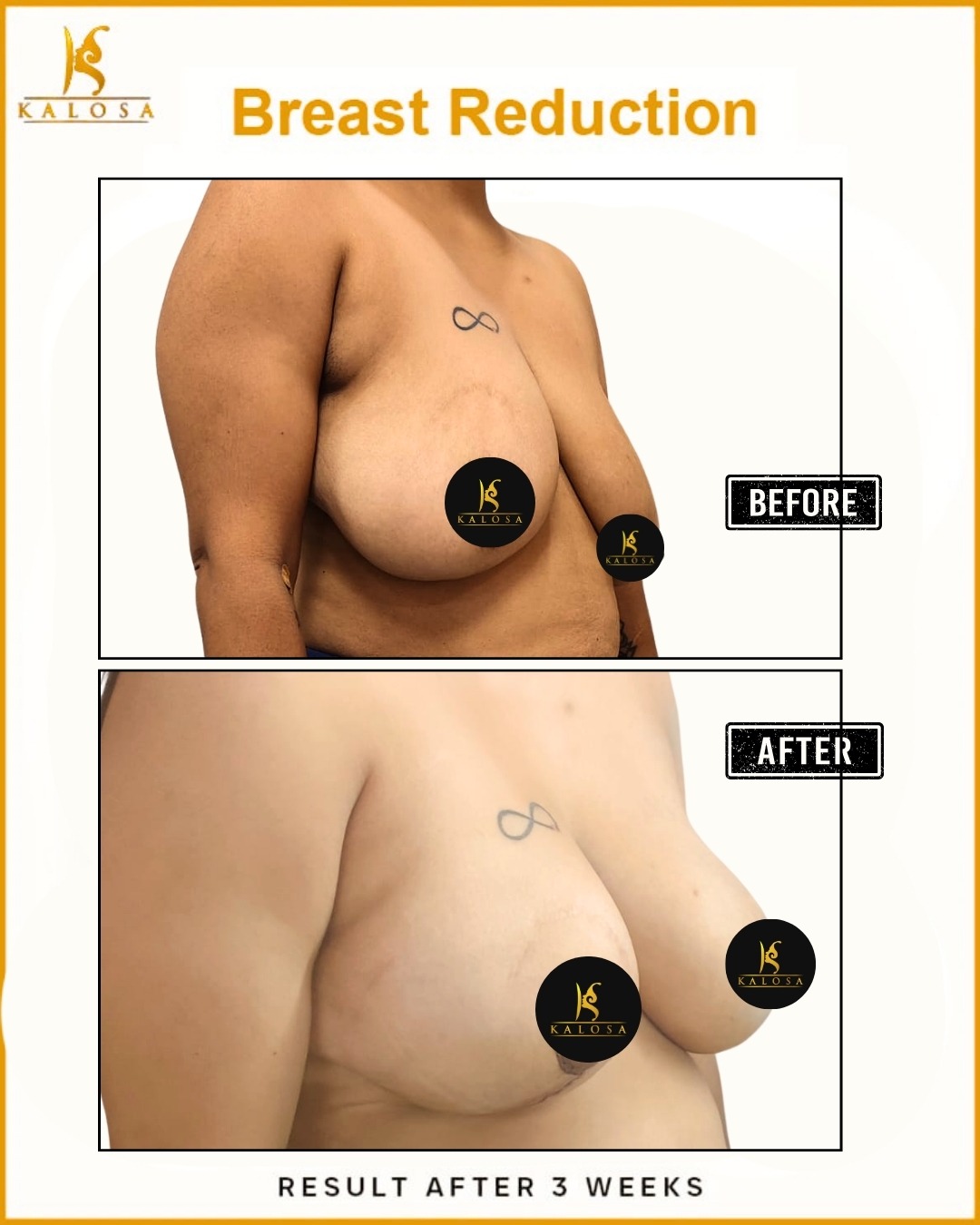 Breast Reduction