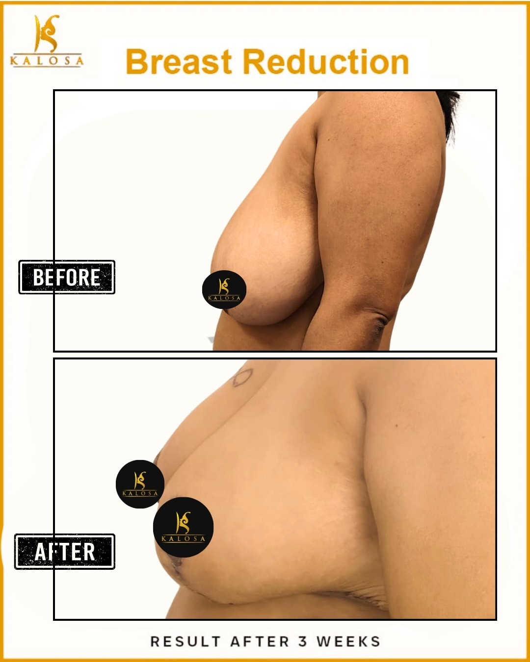 Breast Reduction