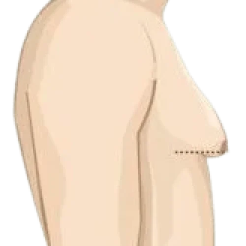 Grades_of_Gynecomastia_3