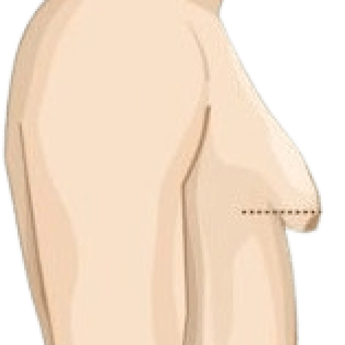Grades_of_Gynecomastia_4-removebg-preview-min.png