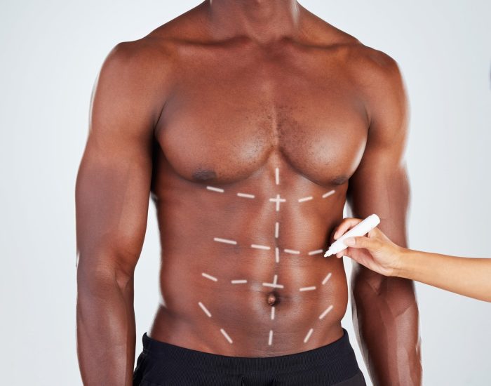 Six Pack Abs Surgery in Gurgaon- Abdominal Etching Treatment in Gurgaon by Dr. Ashish Khare