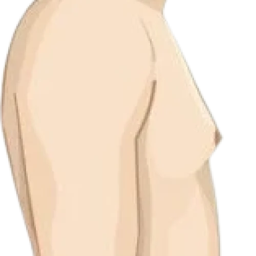 gynecomastia-surgery-grade-1