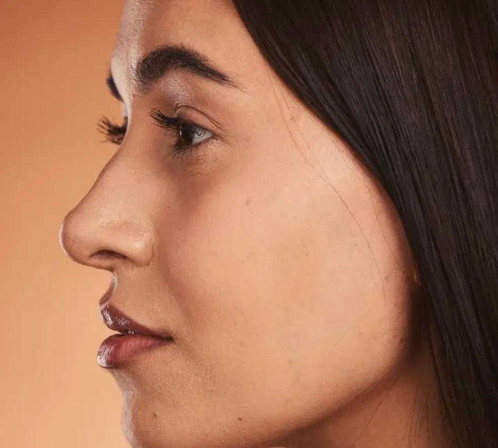 Rhinoplasty Gurgaon before and after